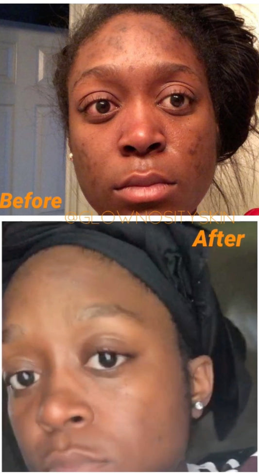 High pigmentation ? Dark Spots on Face ??